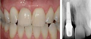 dental implants