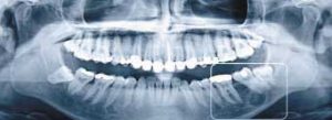 dental implans x-ray