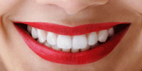 teeth whitening rendondo beach