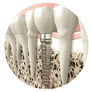 Dental implants Redondo Beach, CA