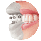 invisalign, dentist Redondo Beach, CA