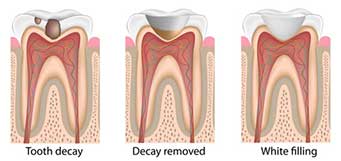 Difference Between A Dental Filling And A Dental Crown | Dentist ...