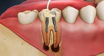 root canals