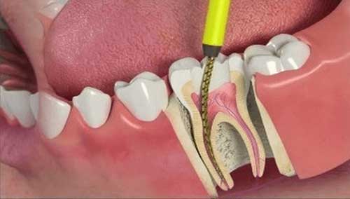 dental Root canals